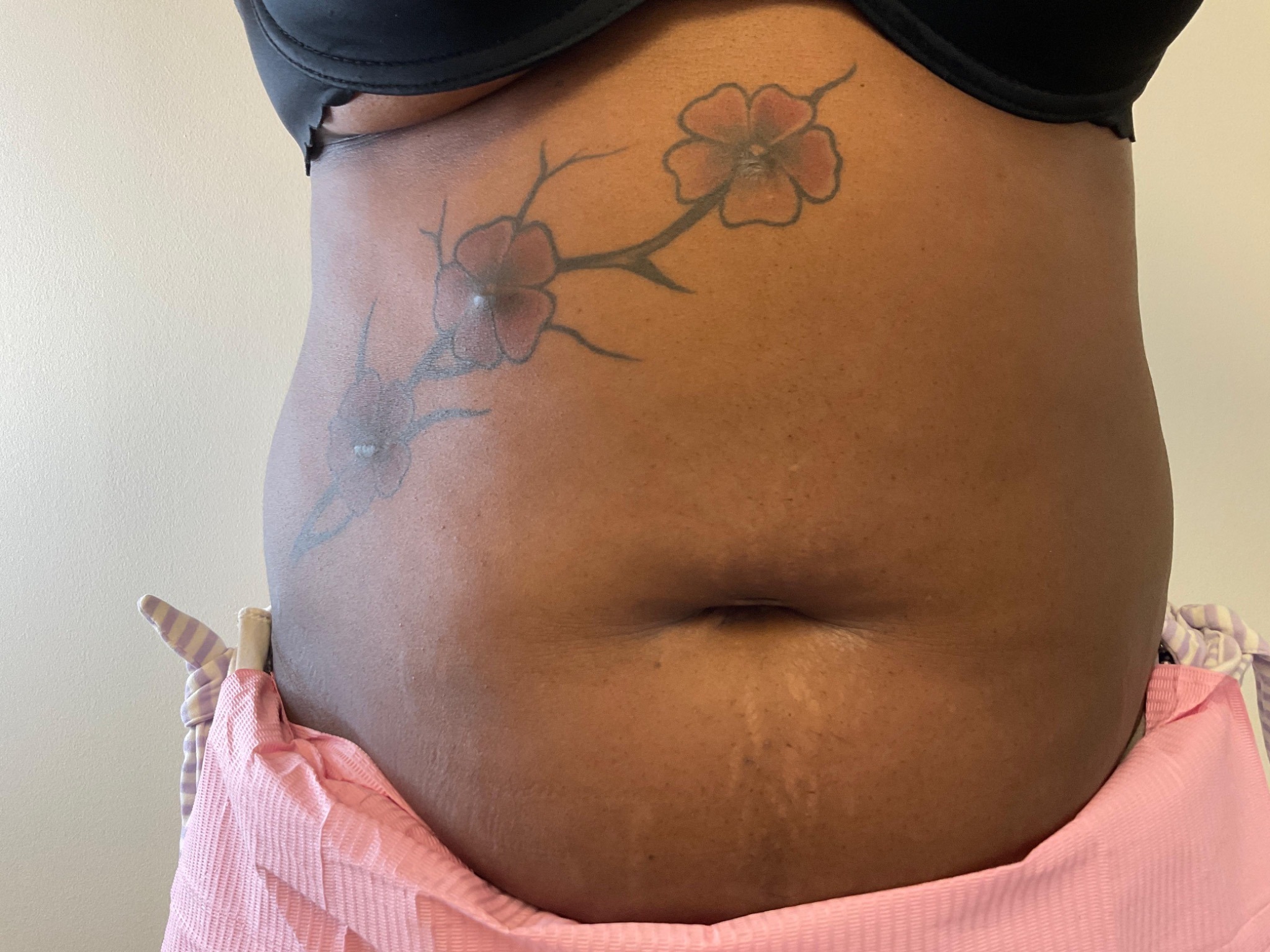 Fat dissolving after