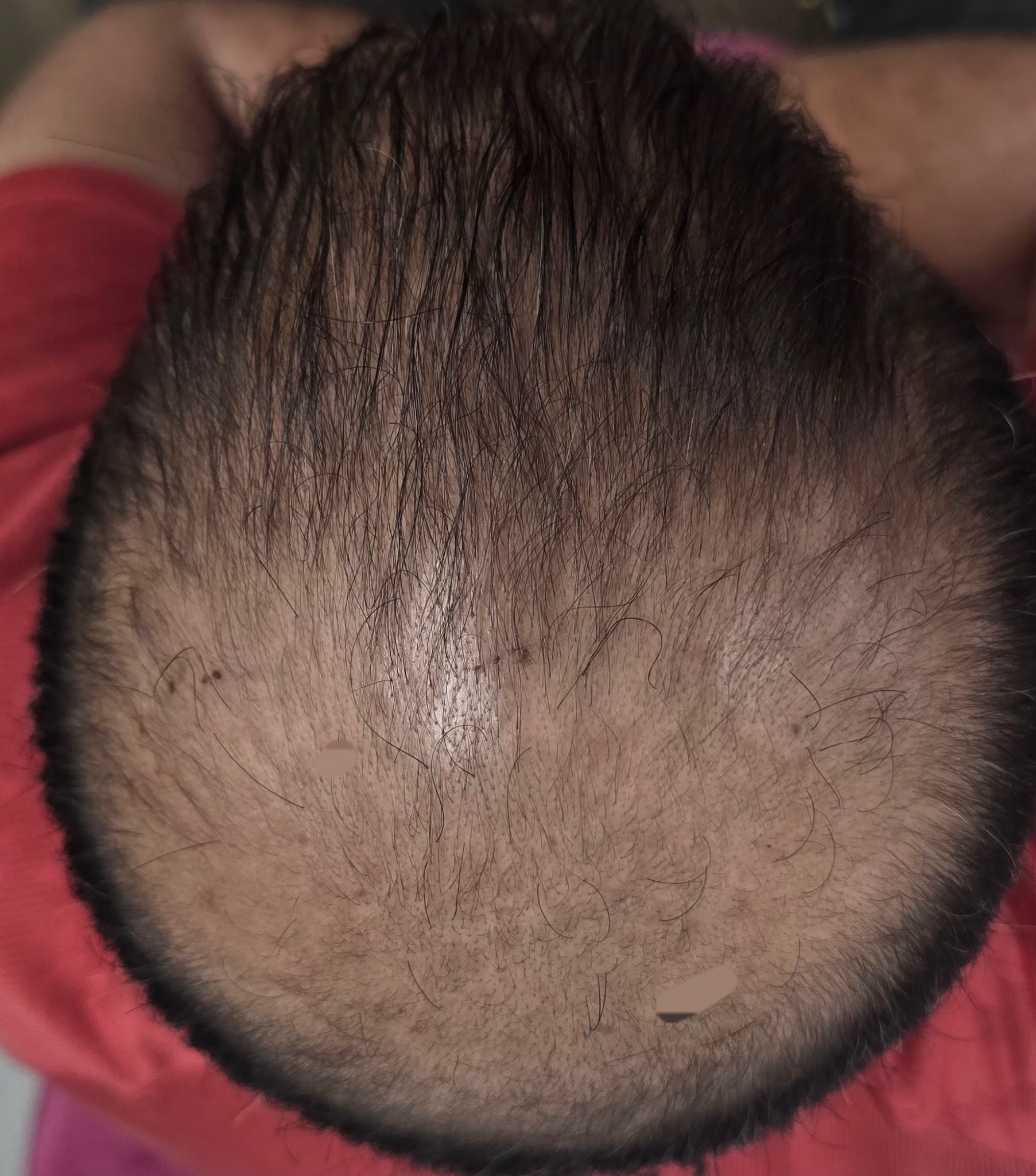 Improved density after PRP