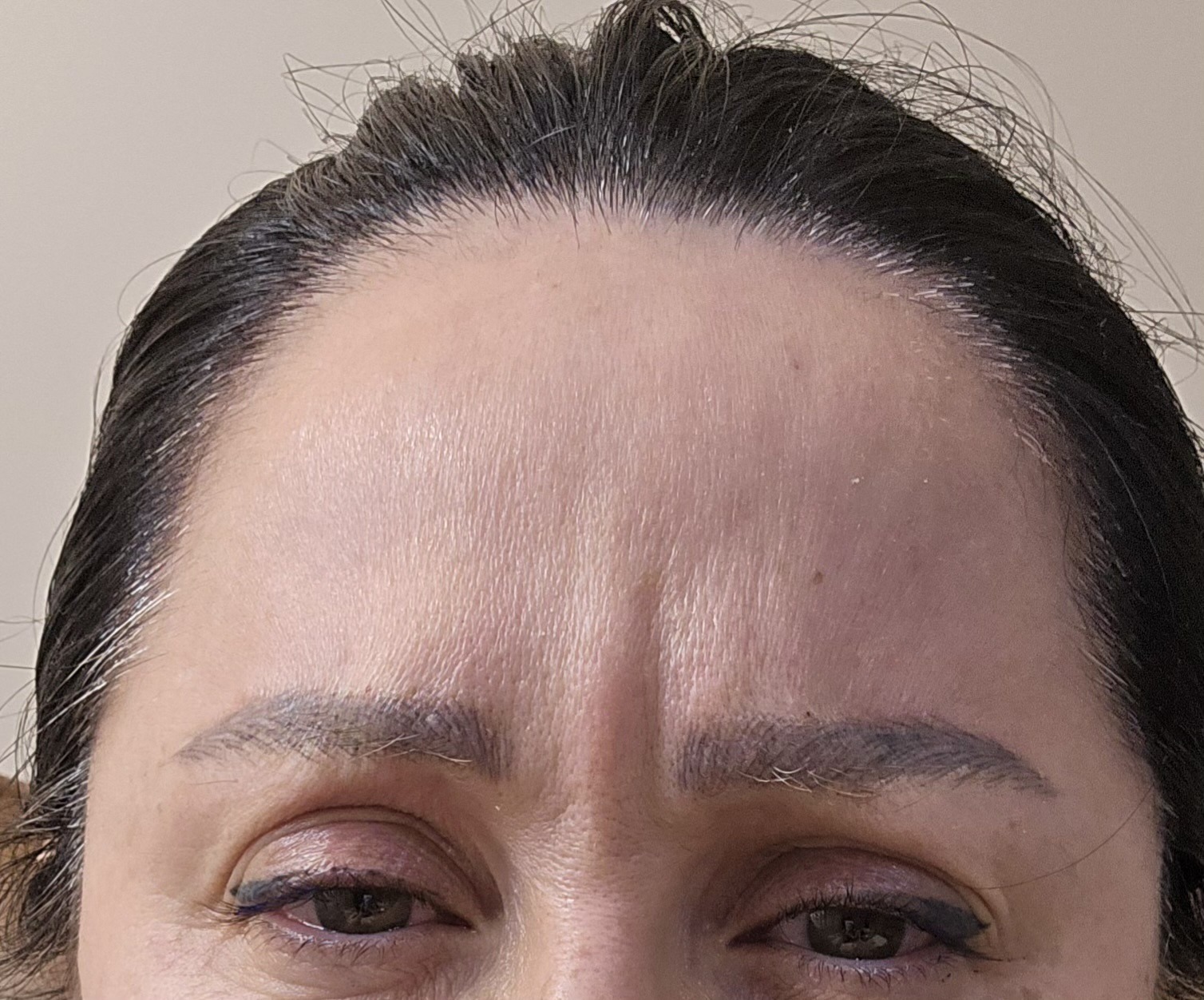 Forehead before neuromodulator